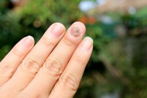 Fungus Infection on Nails Hand, Finger with onychomycosisFungus Infection on Nails Hand, Finger with onychomycosis